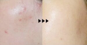 Trị mụn trứng cá bằng công nghệ cao, không để lại thâm, sẹo rỗ 3 Trị mụn trứng cá