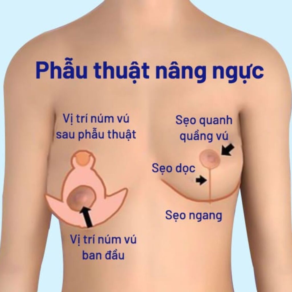 Nâng ngực đẹp tự nhiên tại thẩm mỹ viện uy tín Cần Thơ 1 Nâng ngực