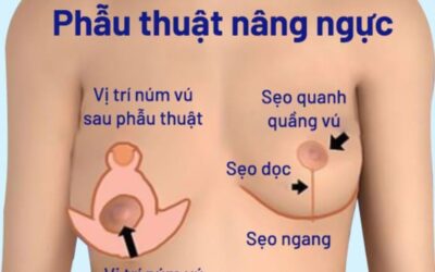 Nâng ngực đẹp tự nhiên tại thẩm mỹ viện uy tín Cần Thơ