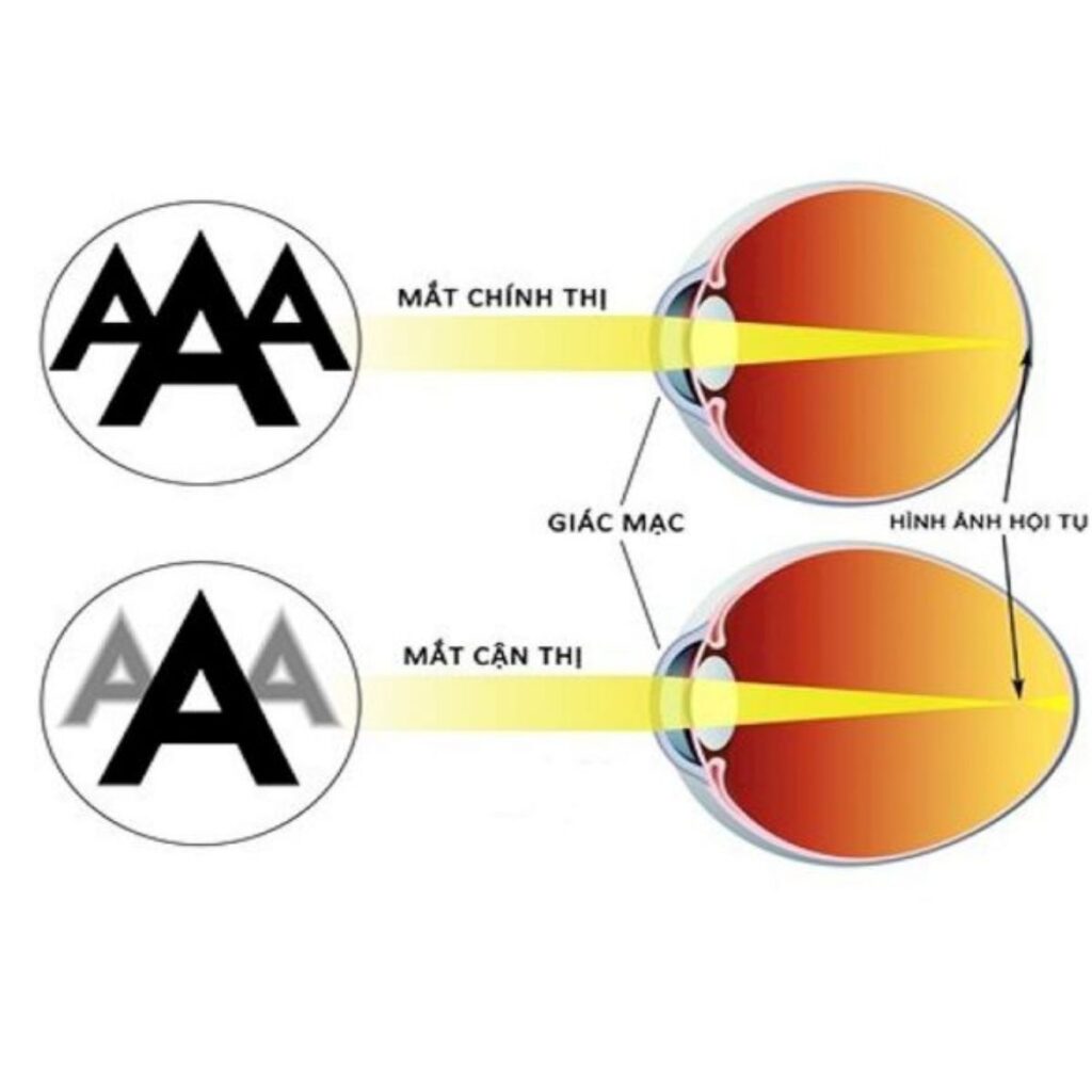 Bị cận thị có cắt mí hoặc nhấn mí được không? 2 Cận thị có nên nhấn mí, cắt mí không