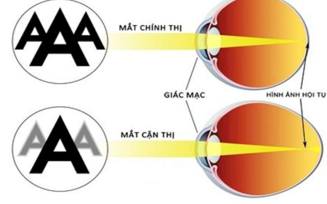 Bị cận thị có cắt mí hoặc nhấn mí được không?