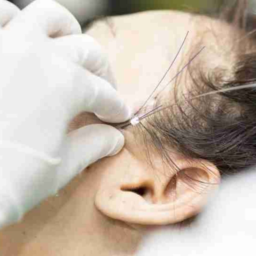 Hiểu rõ vùng da trán và thái dương
