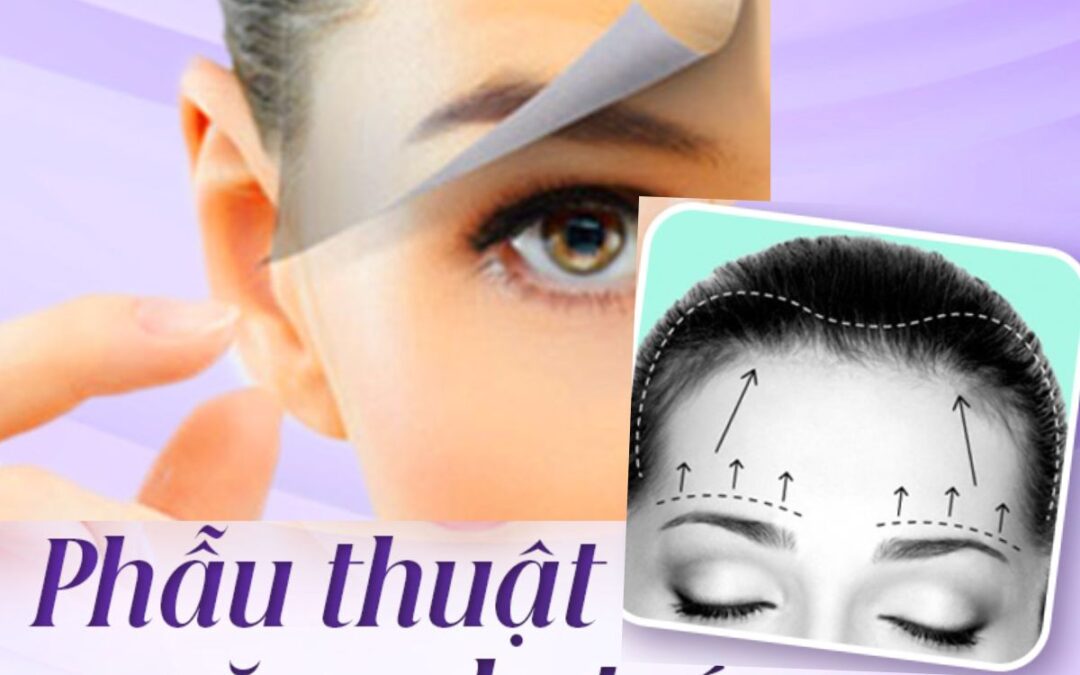 Căng da trán, thái dương – Giải pháp cải thiện vùng lão hóa