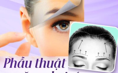 Căng da trán, thái dương – Giải pháp cải thiện vùng lão hóa