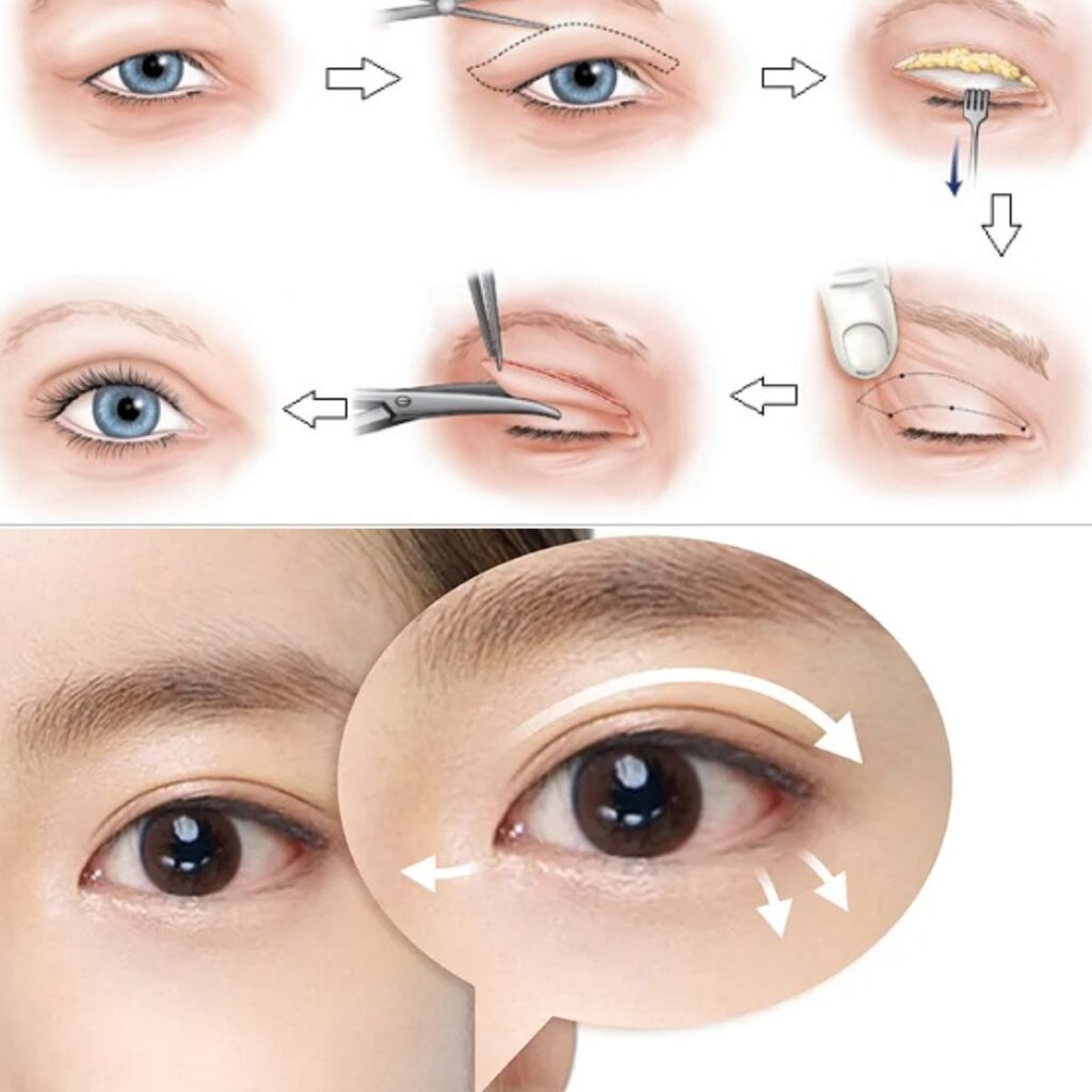 Cắt mí mắt bao lâu thì hồi phục? Các giai đoạn lành thương bạn nên biết 3 Cắt mí mắt bao lâu phục hồi