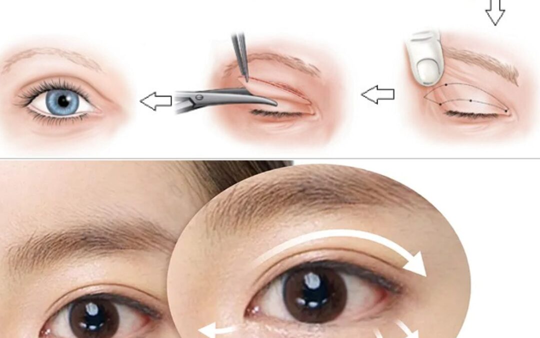 Cắt mí mắt bao lâu thì hồi phục? Các giai đoạn lành thương bạn nên biết