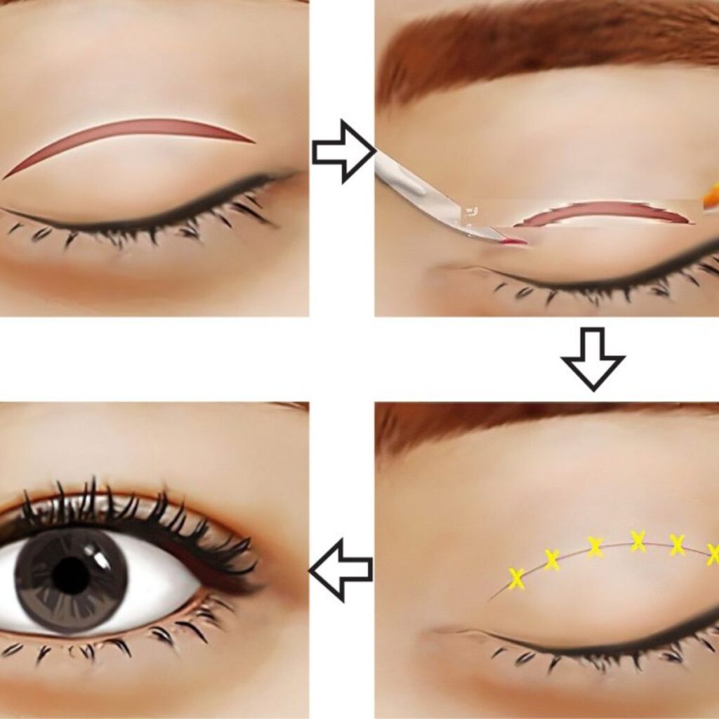 Cắt mí mắt bao lâu thì hồi phục? Các giai đoạn lành thương bạn nên biết 2 Quy trình cắt mí, thẩm mỹ viện Huỳnh Mai