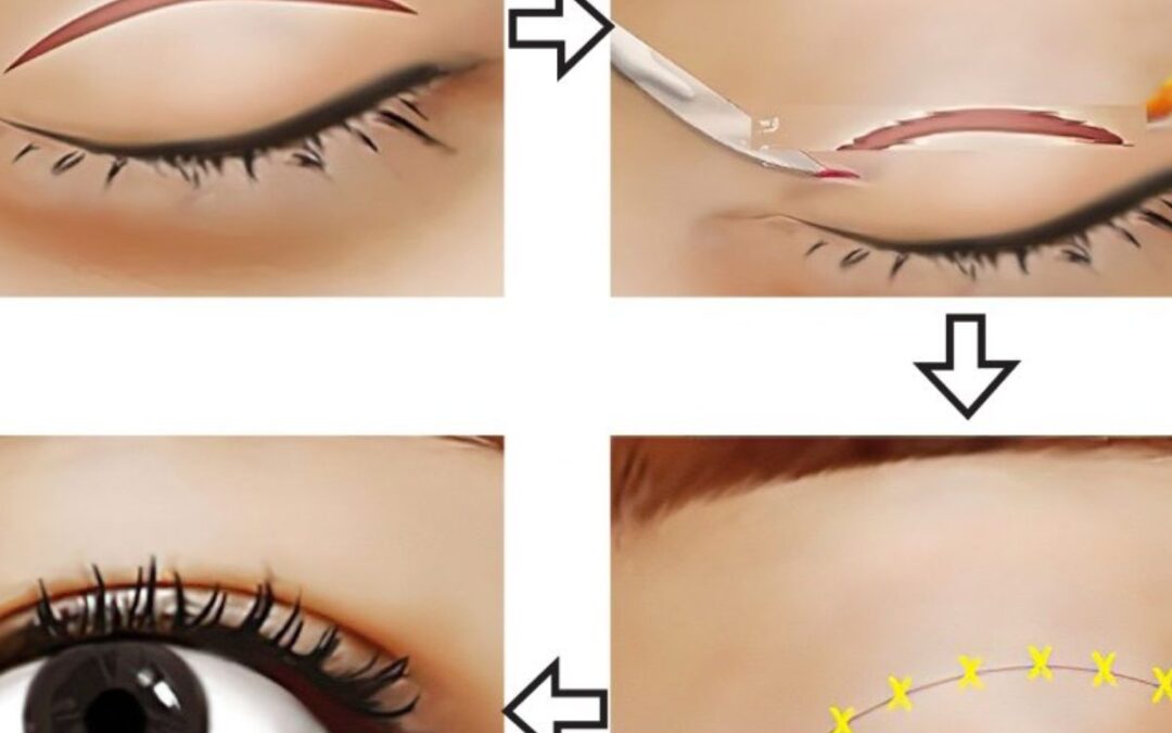 Lưu ý trước và sau khi cắt mí để không bị biến chứng