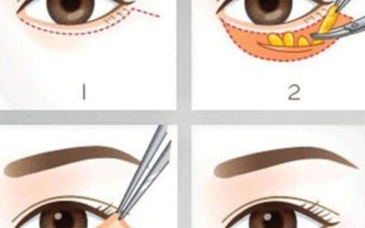 Cắt mắt 2 mí: Giá bao nhiêu, có đau không?