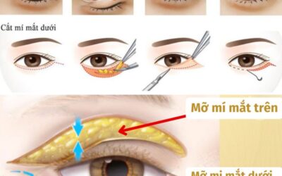 Cắt mí dưới có ảnh hưởng đến thị lực không? Bao lâu thì lành?