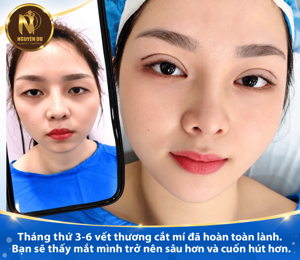 Cắt mí mắt bao lâu thì hồi phục? 