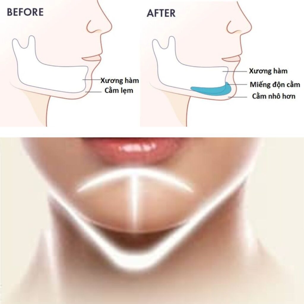 Phun xăm lông mày ở Cần Thơ: Giữ được lâu và thẩm mỹ viện uy tín? 5 Độn cằm V-line là gì? Nên lưu ý gì sau khi độn cằm