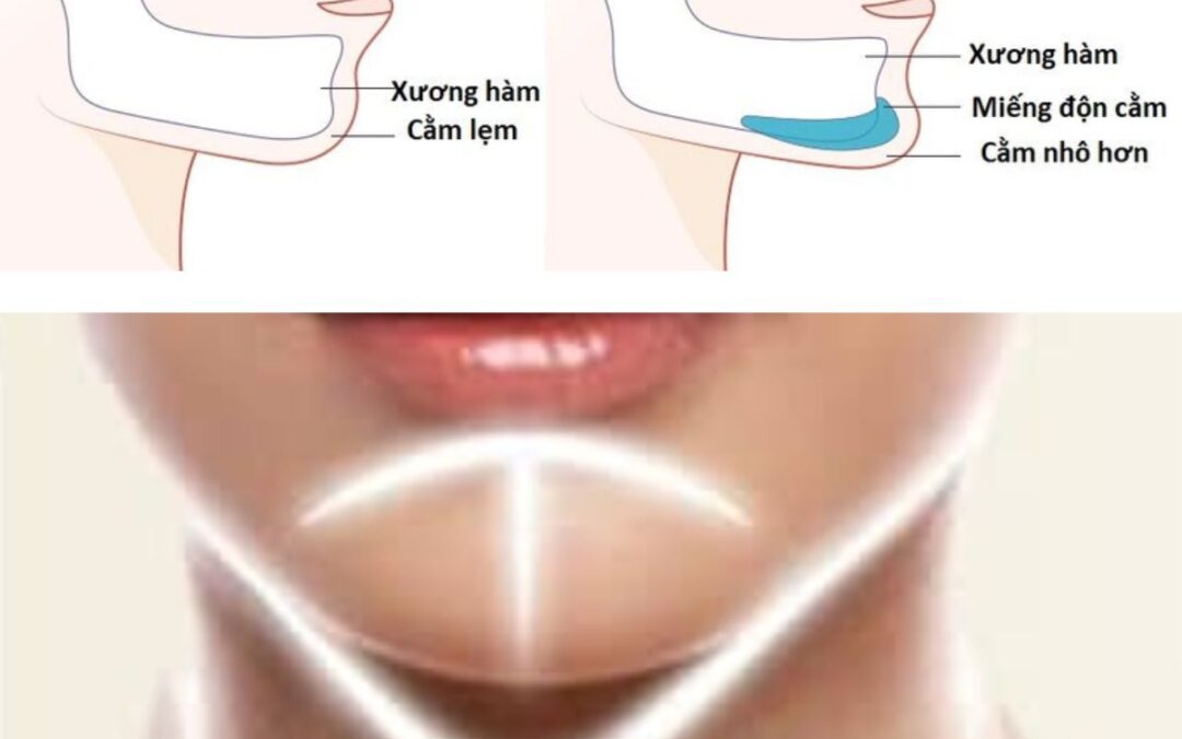 Độn cằm V-line ở đâu uy tín? Những lưu ý sau khi độn cằm