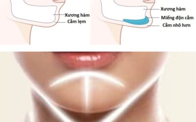 Độn cằm V-line ở đâu uy tín? Những lưu ý sau khi độn cằm