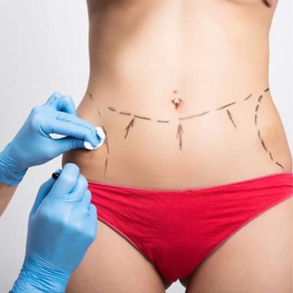 Những điều cần chuẩn bị và lưu ý trước khi hút mỡ bụng