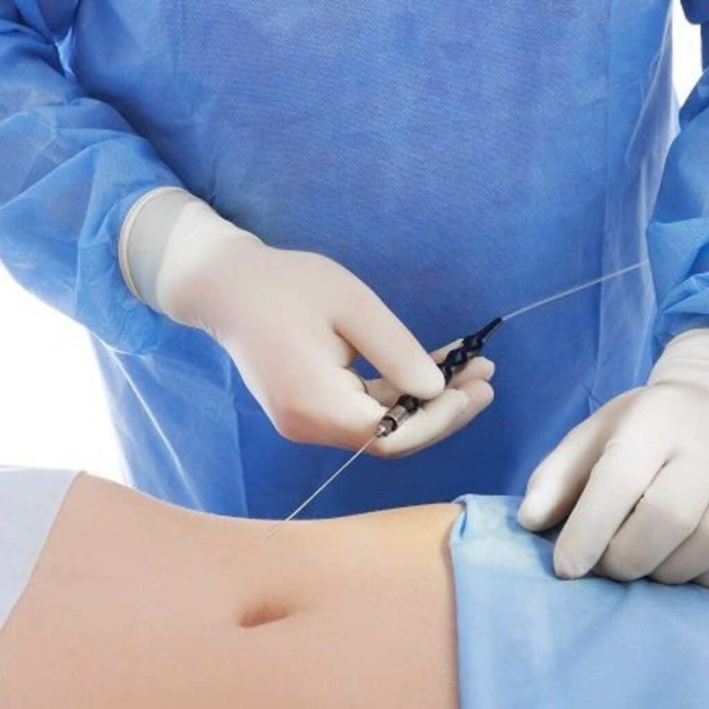 Quá trình thực hiện hút mỡ bụng và cảm giác thực tế