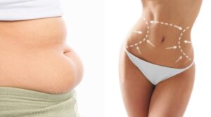  Kết quả hút mỡ bụng: Hài lòng hay thất vọng?