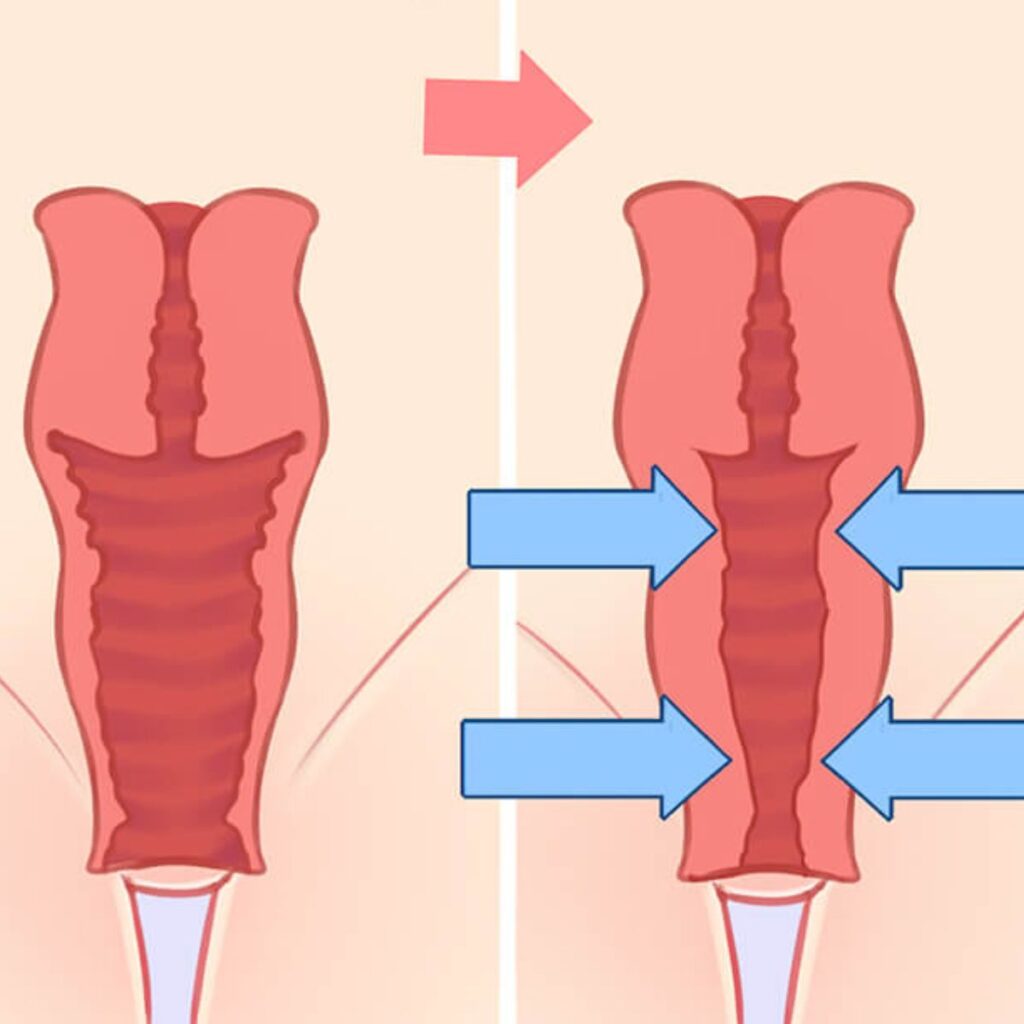 Phẫu thuật thu nhỏ âm đạo