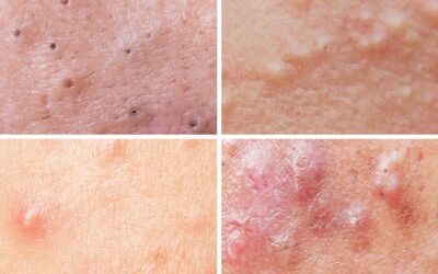 Trị mụn trứng cá bằng công nghệ cao, không để lại thâm, sẹo rỗ