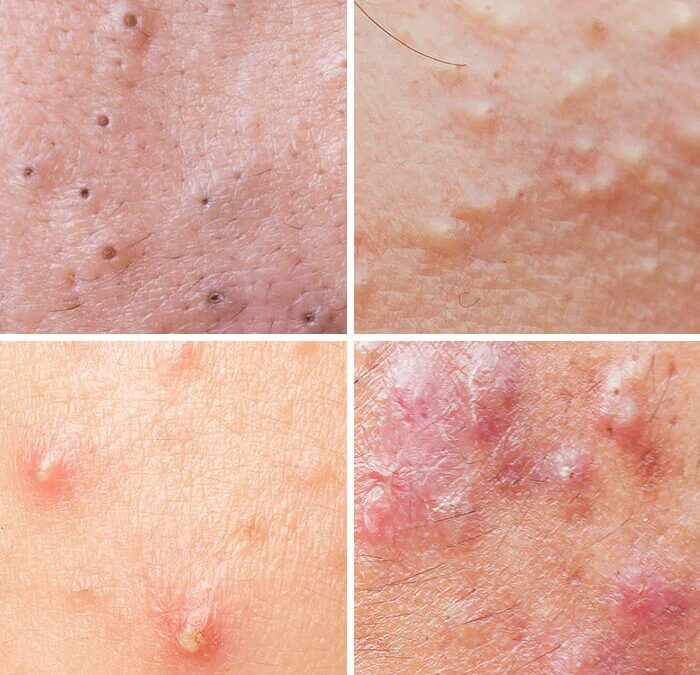 Trị mụn trứng cá bằng công nghệ cao, không để lại thâm, sẹo rỗ