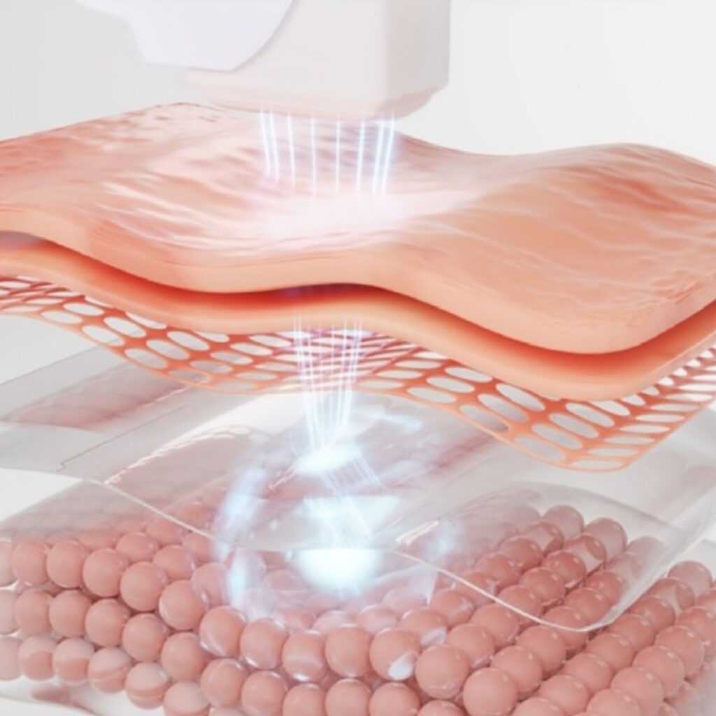 Nâng cơ mặt không xâm lấn bằng HIFU - Phù hợp với ai? 3 Lợi ích vượt trội khi nâng cơ mặt bằng công nghệ HIFU