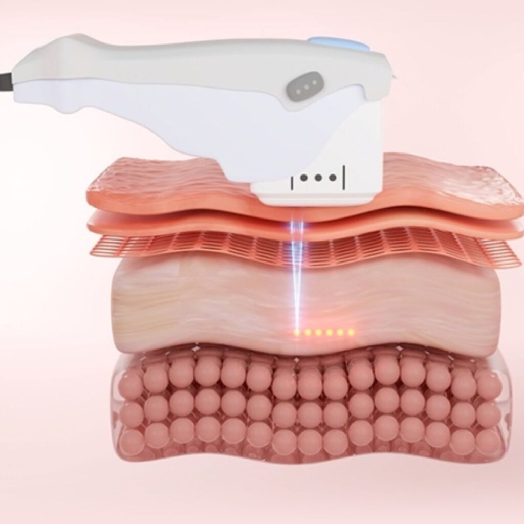 Nâng cơ mặt không xâm lấn bằng HIFU - Phù hợp với ai? 2 HIFU là gì? Cơ chế hoạt động của công nghệ HIFU