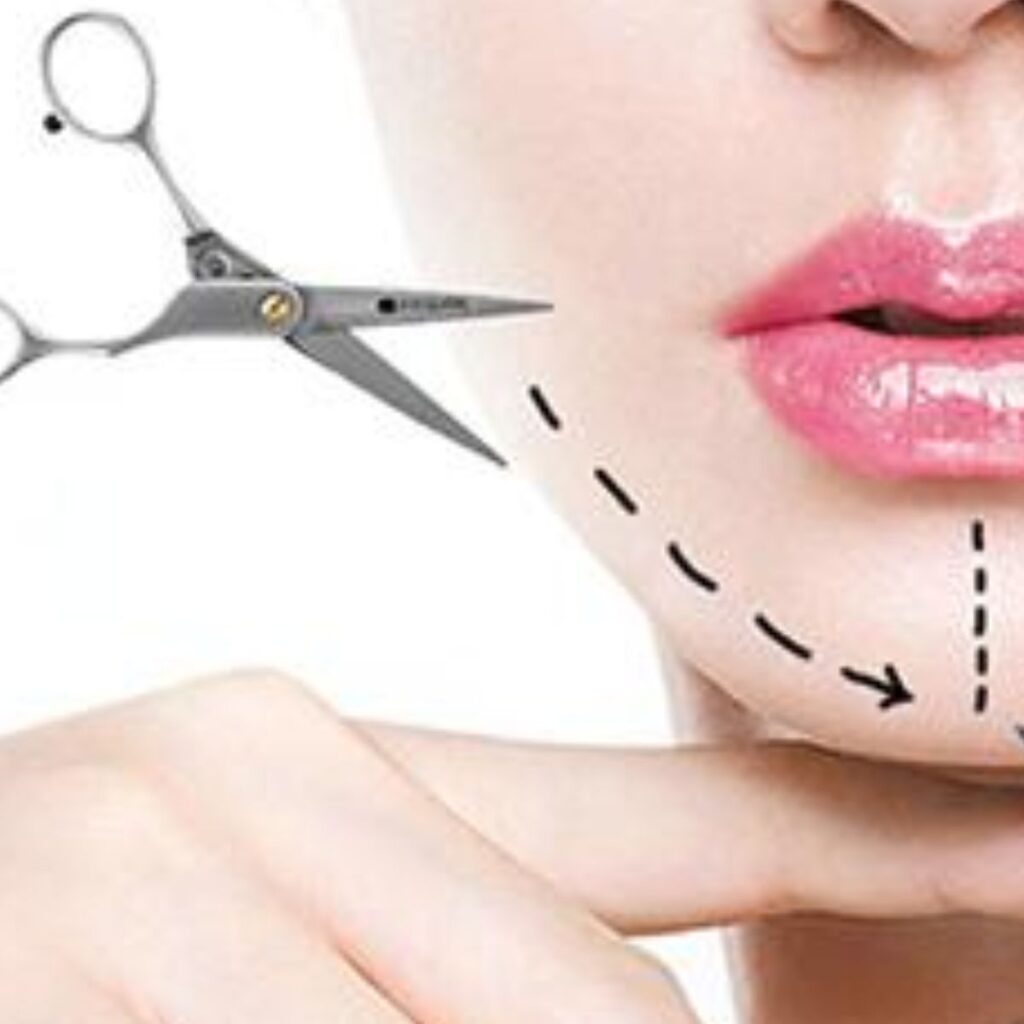 Độn cằm V-line, trượt cằm