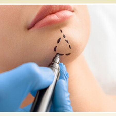 độn cằm độn cằm