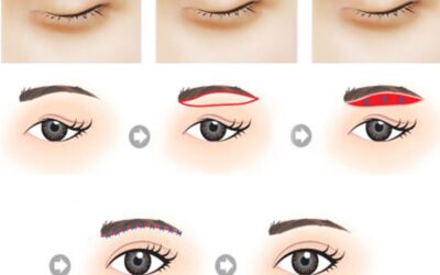 Phẫu thuật nâng cung mày tại thẩm mỹ viện uy tín Cần Thơ