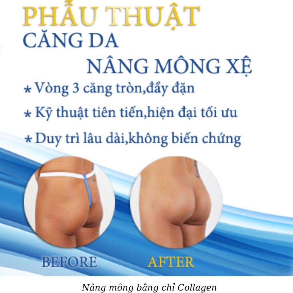 Thẩm mỹ viện Cần Thơ nâng mông đẹp, chuyên nghiệp 4 Nâng mông bằng chỉ Collagen/Chỉ sinh học (Nâng Mông Sculptra)