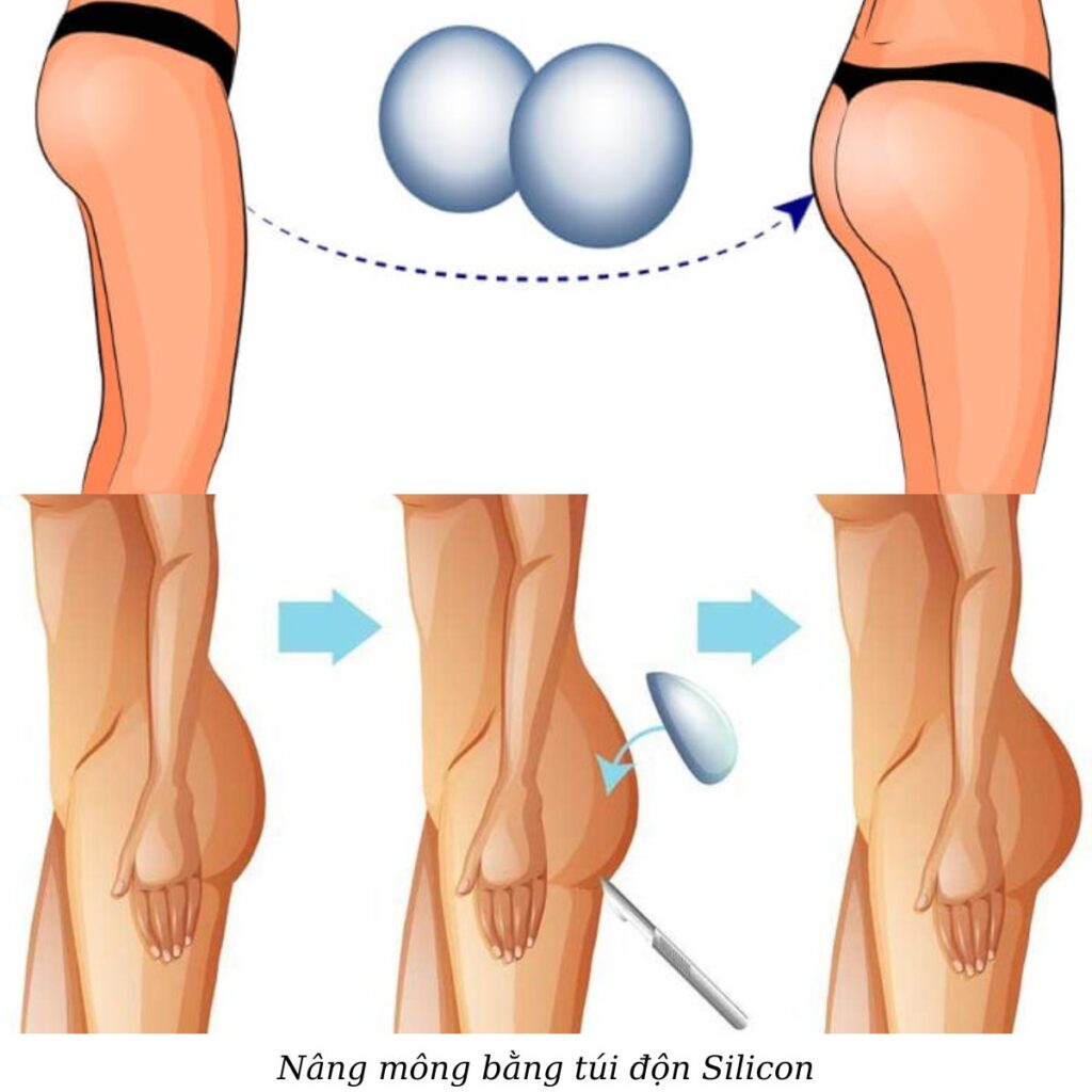 Thẩm mỹ viện Cần Thơ nâng mông đẹp, chuyên nghiệp 3 Nâng mông bằng túi độn Silicon