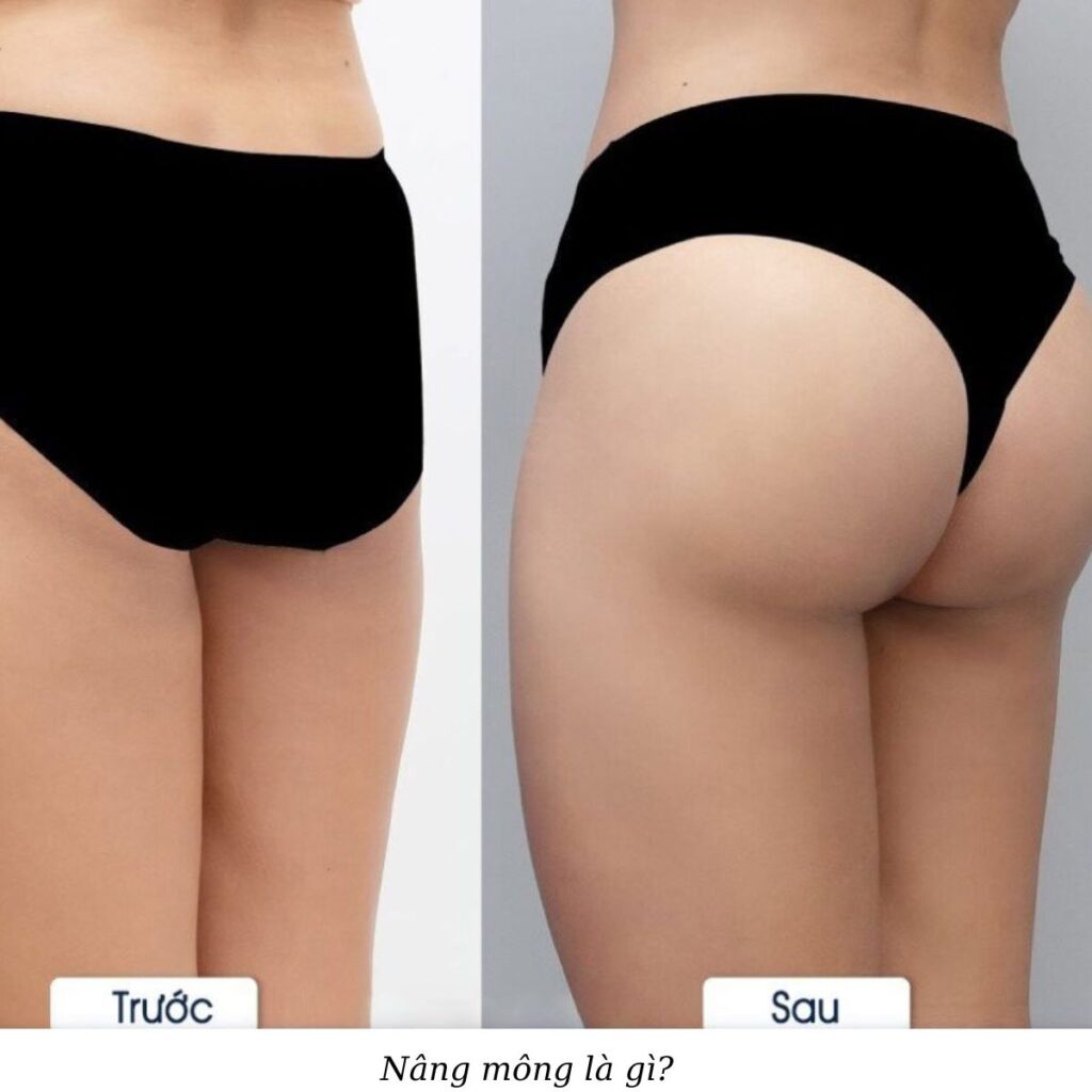 Thẩm mỹ viện Cần Thơ nâng mông đẹp, chuyên nghiệp 1 Nâng mông là gì?