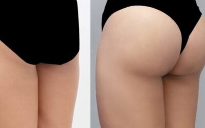 Thẩm mỹ viện Cần Thơ nâng mông đẹp, chuyên nghiệp