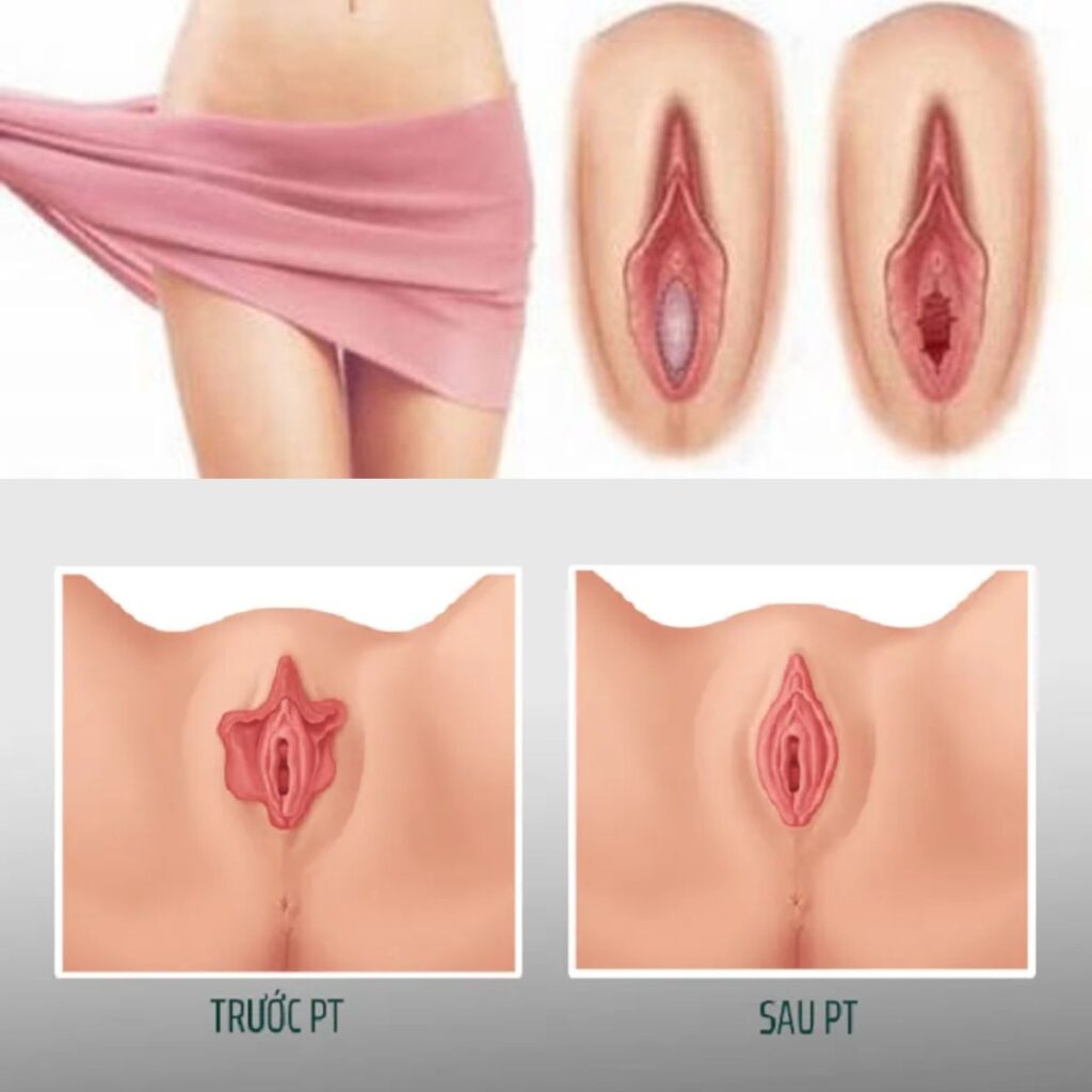 Chi phí thẩm mỹ cô bé 