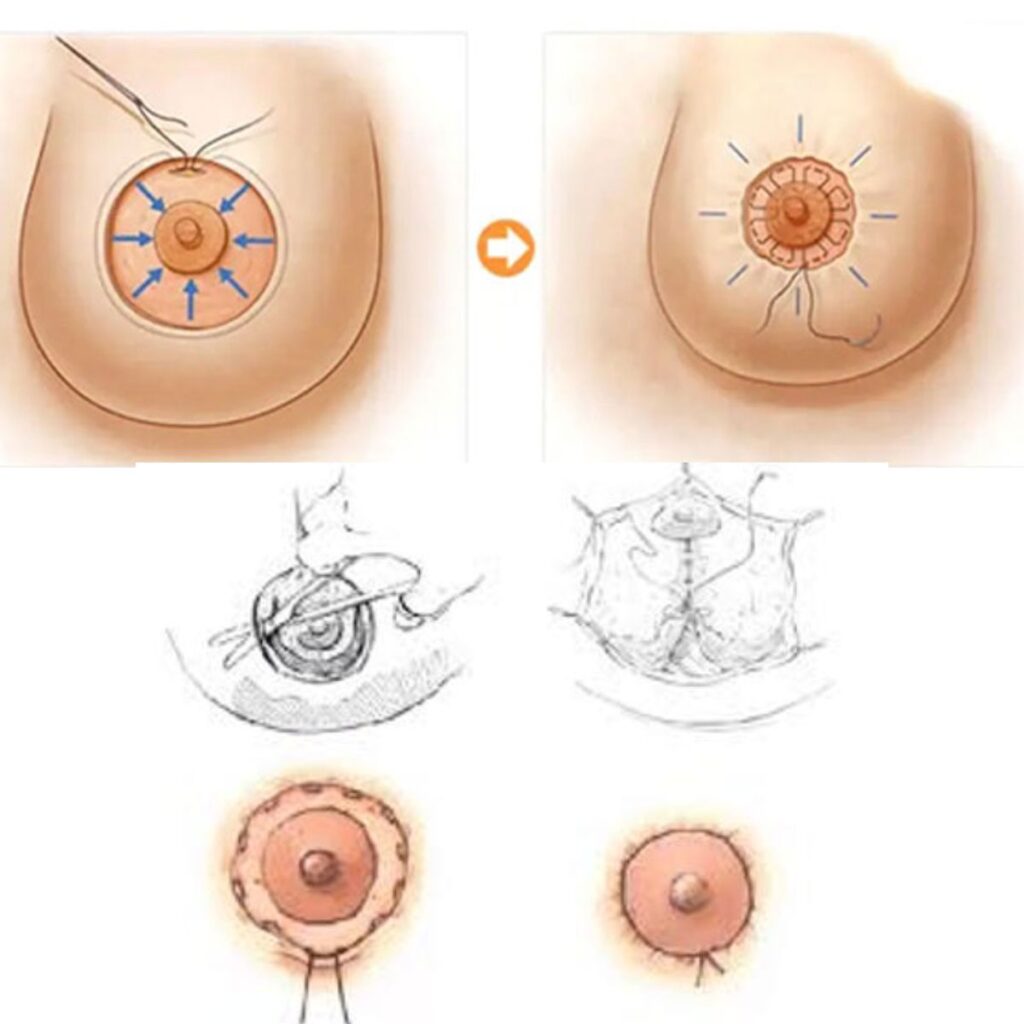 Thu gọn quầng nhũ hoa hiệu quả tại thẩm mỹ viện Cần Thơ 4 Thẩm mỹ viện Huỳnh Mai Cần Thơ – Địa chỉ thu gọn quần phấn hoa uy tín