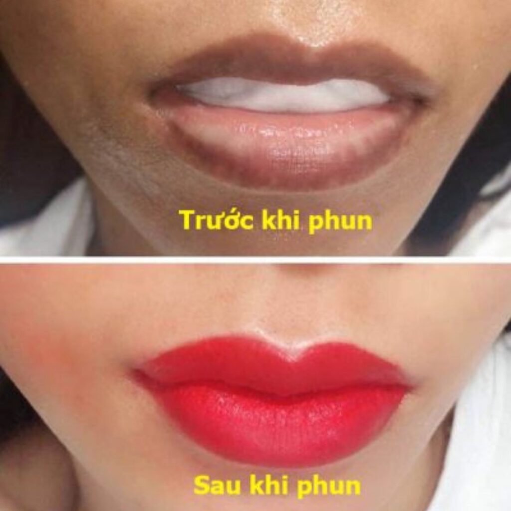 Phun môi collagen là gì? Môi thâm có lên màu được không? 3 Môi thâm có phun collagen được không
