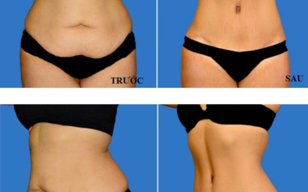 Phẫu thuật tạo hình thành bụng và những điều cần lưu ý