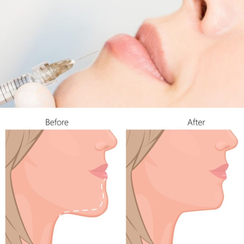 Tiêm filler bao lâu thì tan? Có cần tiêm lại định kỳ? 4 Tiêm filler cằm tại thẩm mỹ viện uy tín Cần Thơ - Thẩm mỹ viện Huỳnh Mai