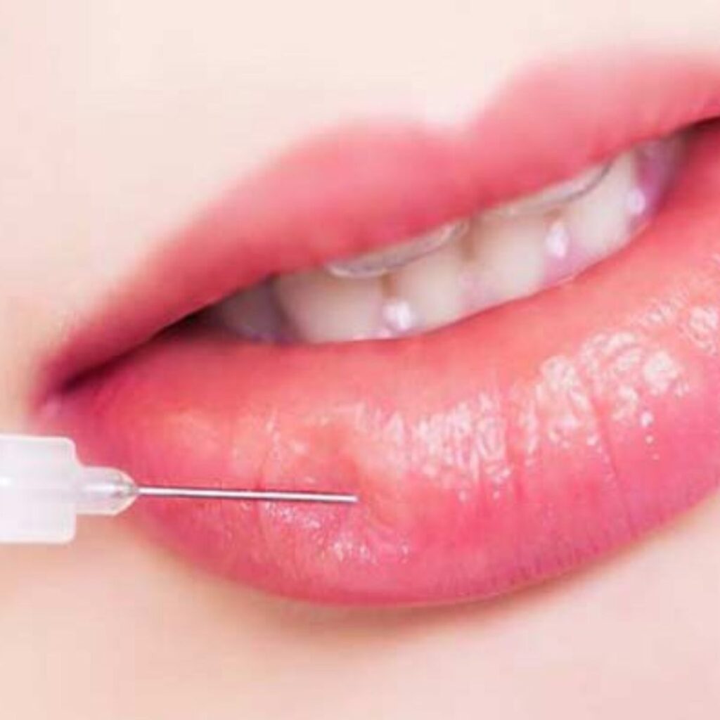 Tiêm filler bao lâu thì tan? Có cần tiêm lại định kỳ? 5 Tiêm filler môi