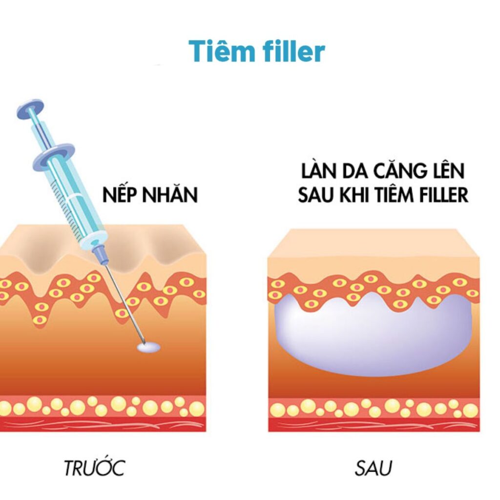 Filler, hay còn gọi là chất làm đầy