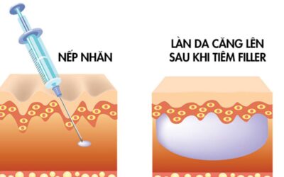 Filler là gì? Có nên tiêm không? Lợi – hại và đối tượng phù hợp