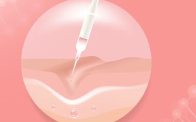 Tiêm filler bao lâu thì tan? Có cần tiêm lại định kỳ?