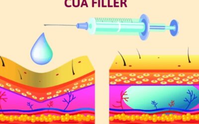 Tiêm filler có an toàn không? 45 tuổi có tiêm được không?