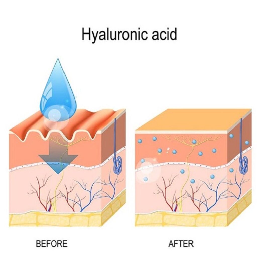 Làm thon gọn mặt bằng cách nào an toàn và hiệu quả lâu dài? 3 Tiêm filler