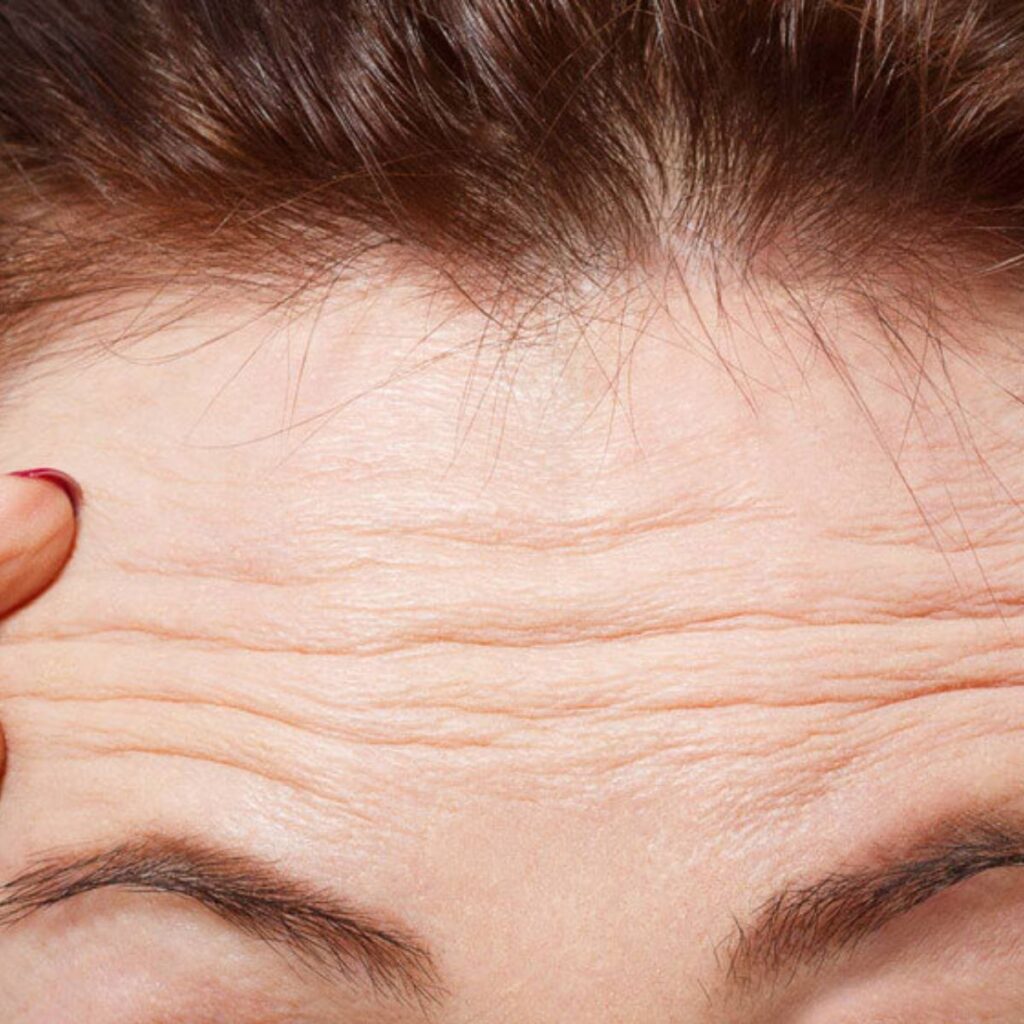 Tiêm filler tuổi 45 