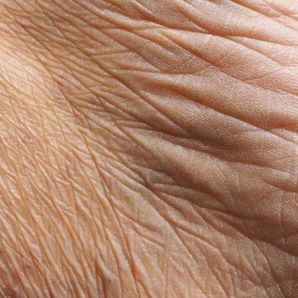 Tiêm filler cho da nhăn chảy xệ ở tuổi 45 