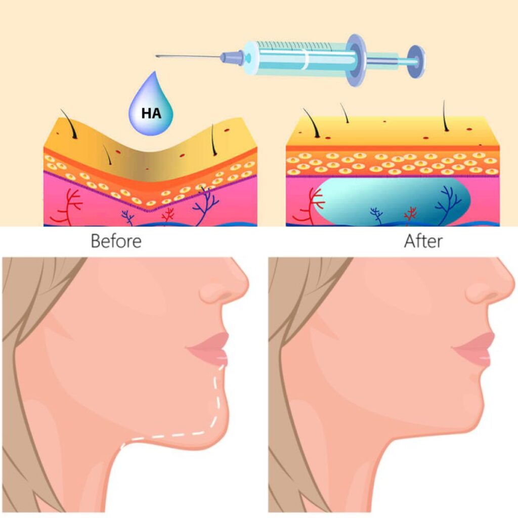 Các vị trí tiêm filler sau tuổi 45 