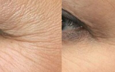 Home 02 4 Tiêm botox xóa nhăn là gì? Tiêm xóa nhăn mắt có ảnh hưởng gì không?