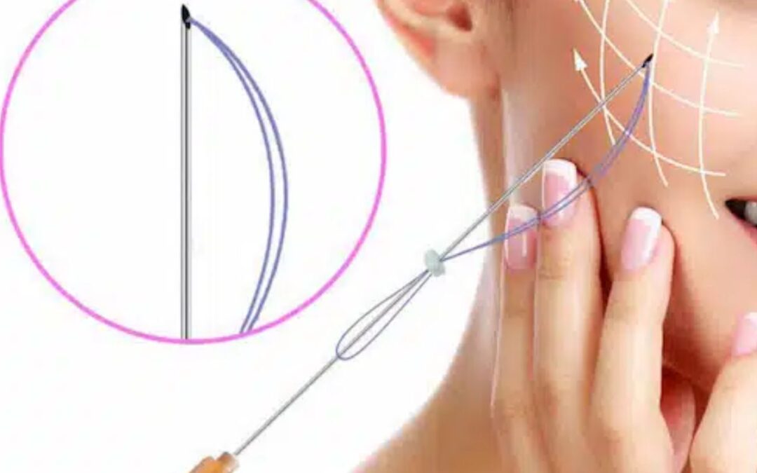 Trẻ hóa gương mặt bằng chỉ collagen có an toàn không?