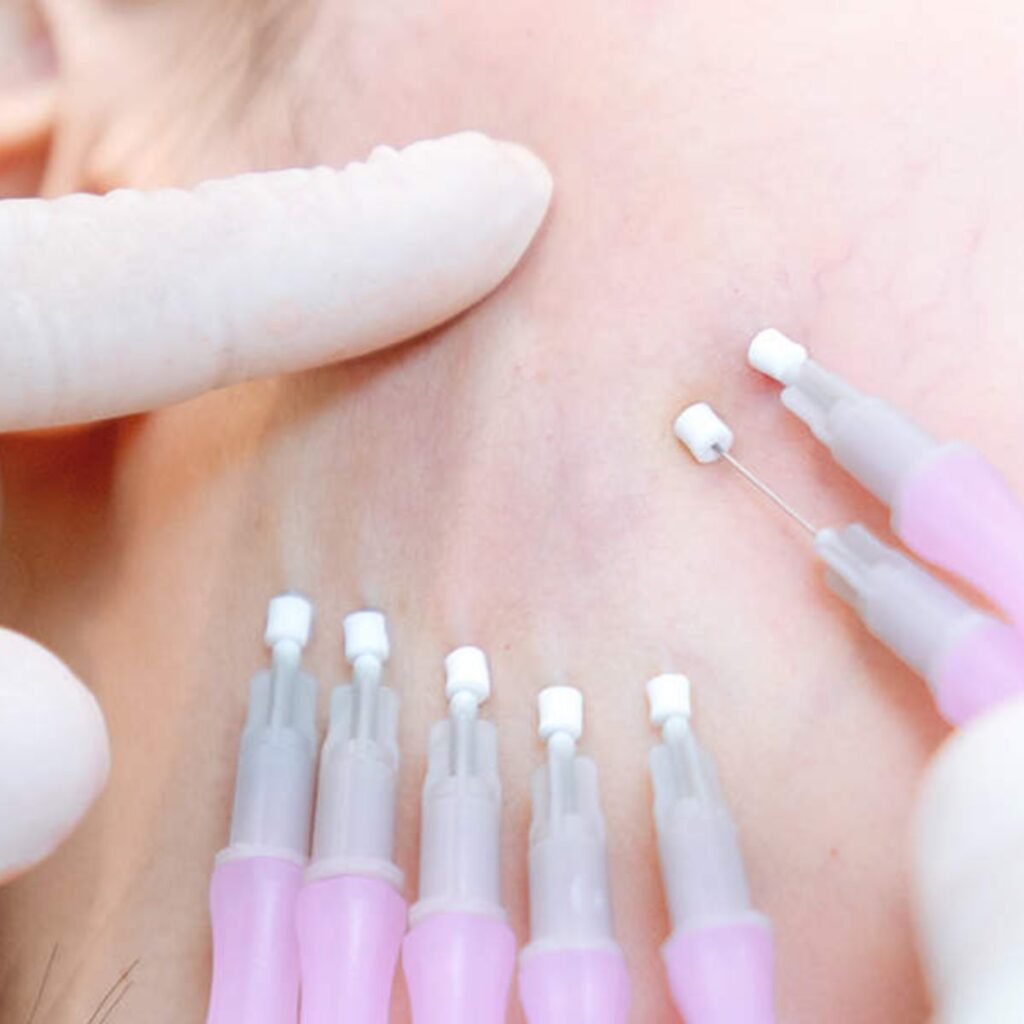 Trẻ hóa gương mặt bằng chỉ Collagen có an toàn không?
